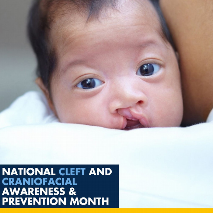 baby with cleft palate