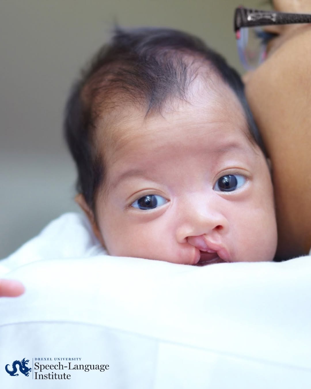 baby with cleft palate