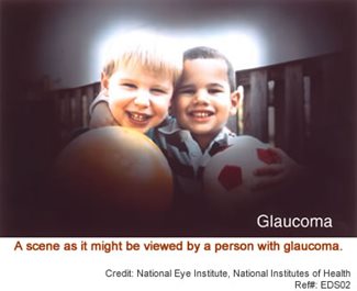 Galucoma vision