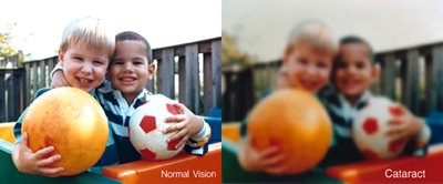 Symptoms of Cataracts