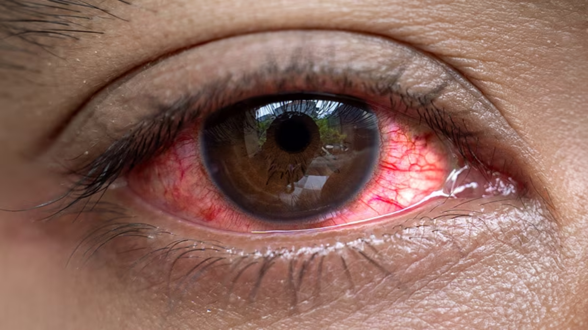 dry-eye-photo-for-newsletter-2.png