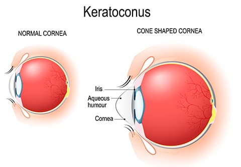 diagram of two eyes (left) shows normal cornea (right) shoes cone shaped cornea